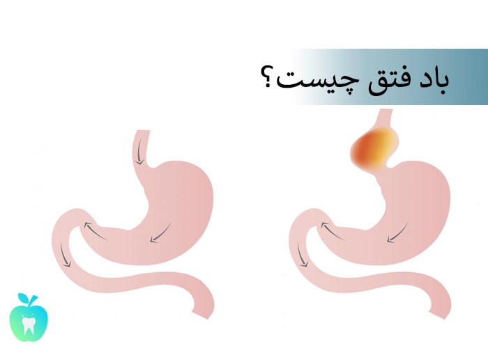 باد فتق چیست؟ آیا فتق خطرناک است