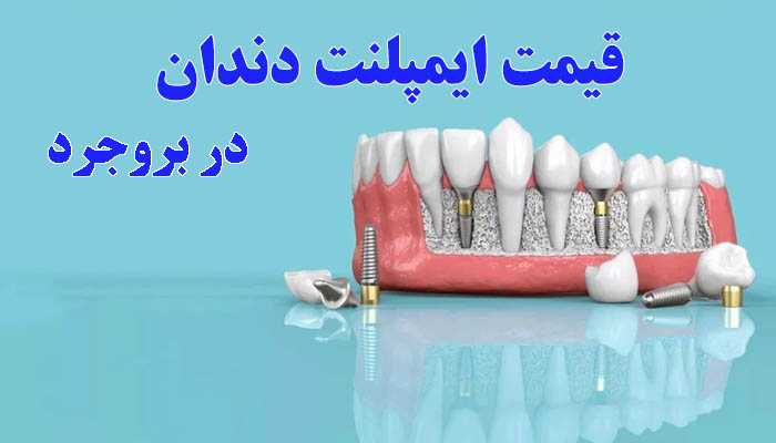 قیمت ایمپلنت دندان در بروجرد 1404