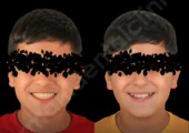 ارتودنسی دندان چیست و دقیقا چه کاری انجام می‌دهد؟