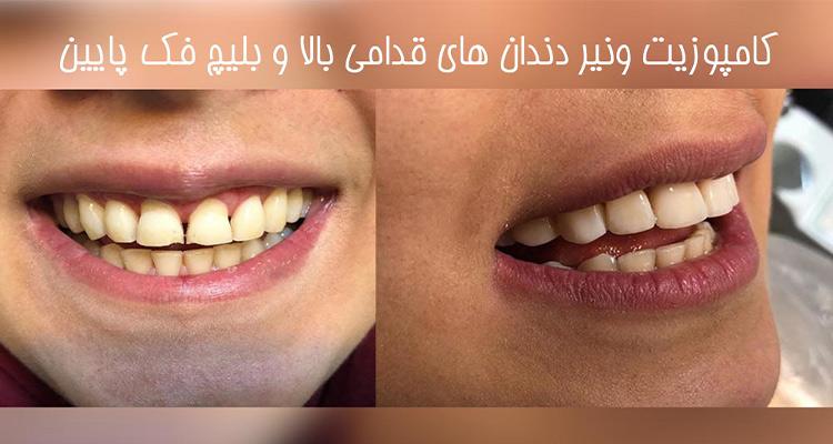 راهنمای کامپوزیت دندان در کرج