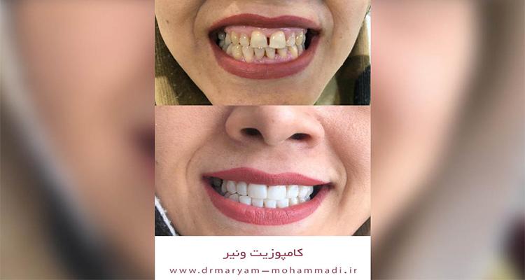 راهنمای کامپوزیت دندان در کرج