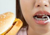 در ارتودنسی ثابت چه چیزی نباید خورد؟