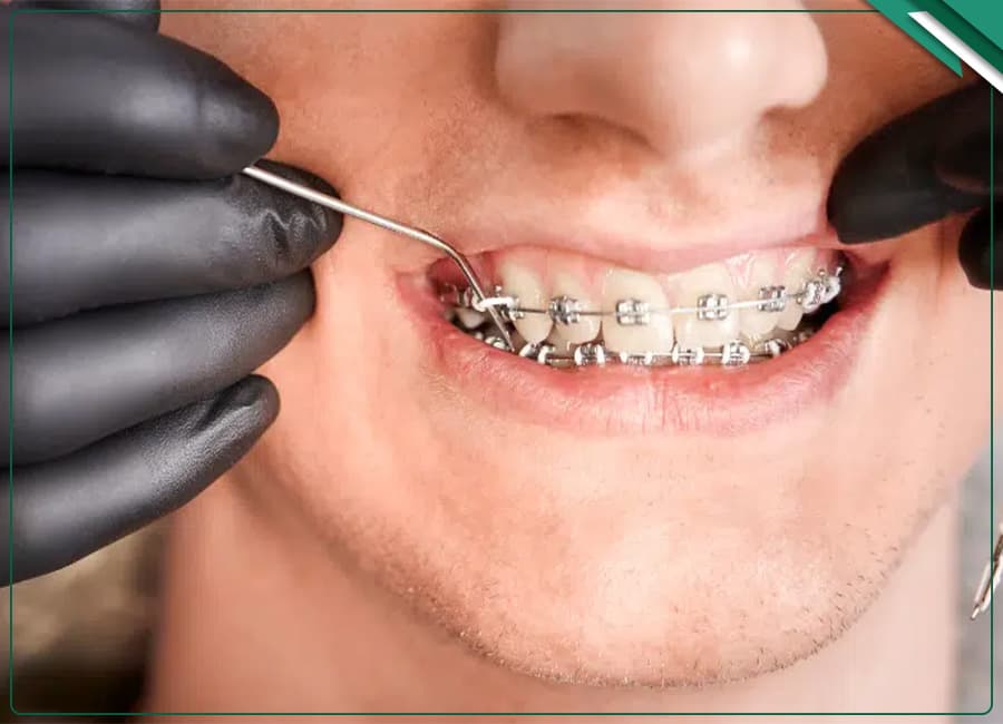 رفتارهای ناخودآگاه مخرب؛ دندانقروچه در ارتودنسی و آسیب به براکتها