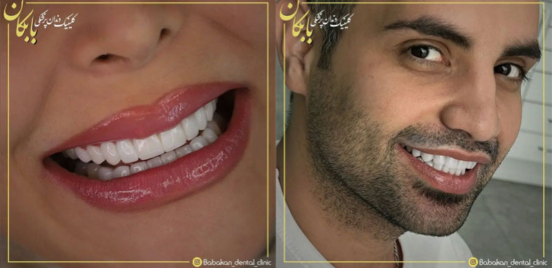 جدیدترین کامپوزیت دندان