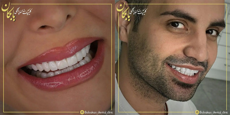 جدیدترین تکنیک های کامپوزیت دندان