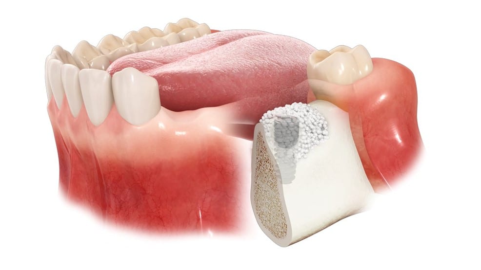 پودر استخوان دندانپزشکی با قیمت عمده؛ راهنمای خرید هوشمندانه برای دندانپزشکان