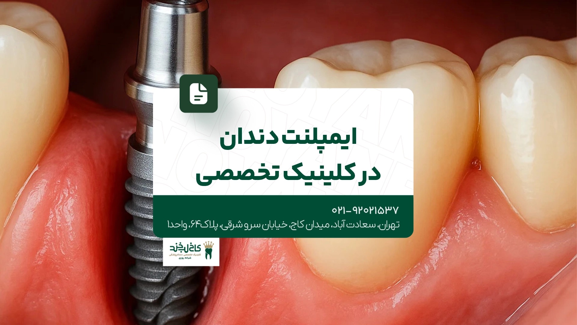 ایمپلنت دندان در کلینیک تخصصی