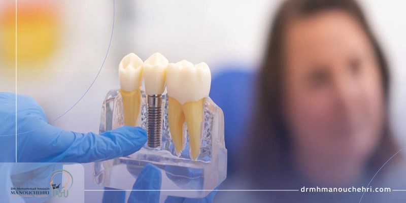 چطور یک دکتر ایمپلنت در اصفهان انتخاب کنیم؟