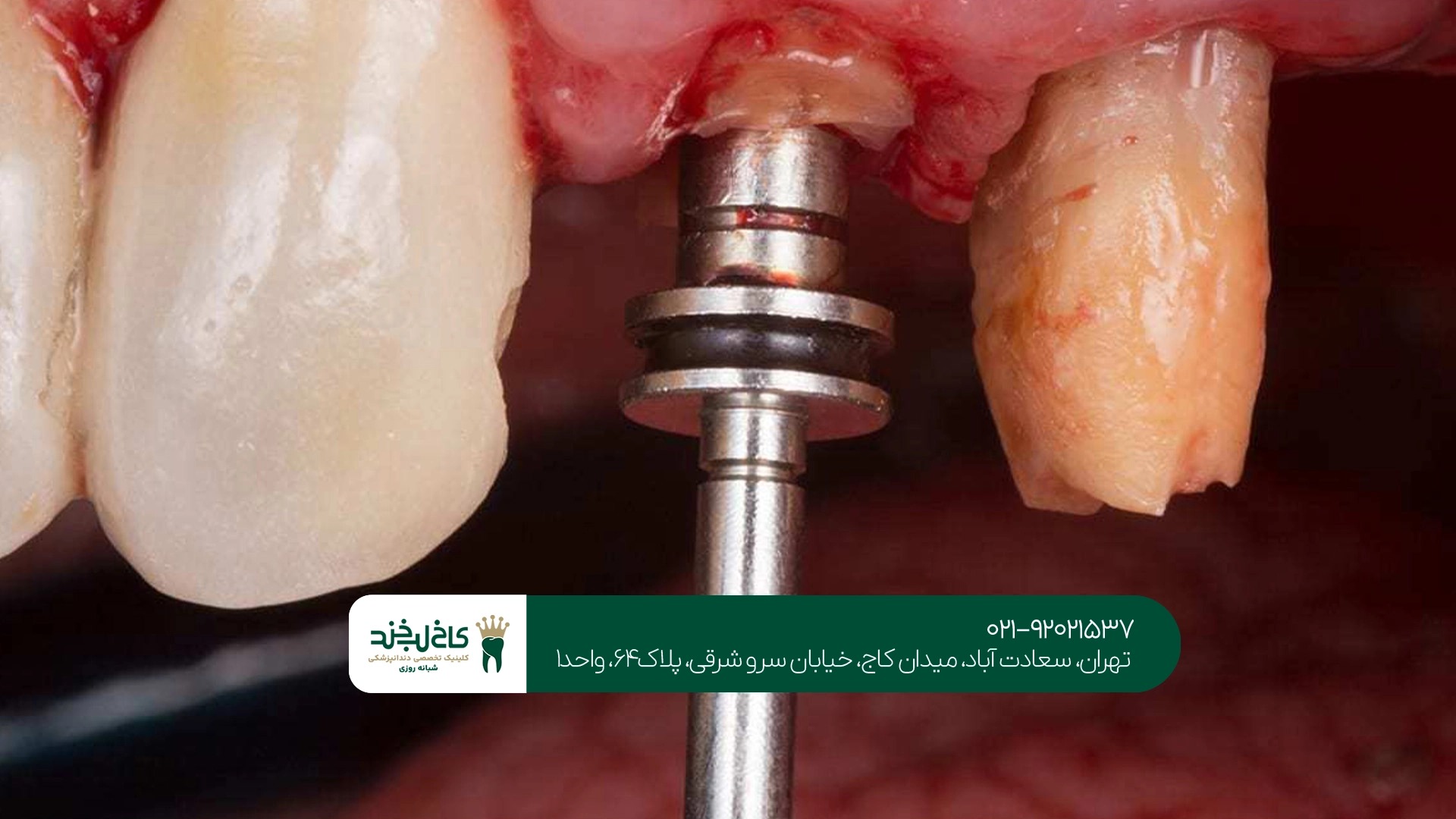 ایمپلنت دیجیتال