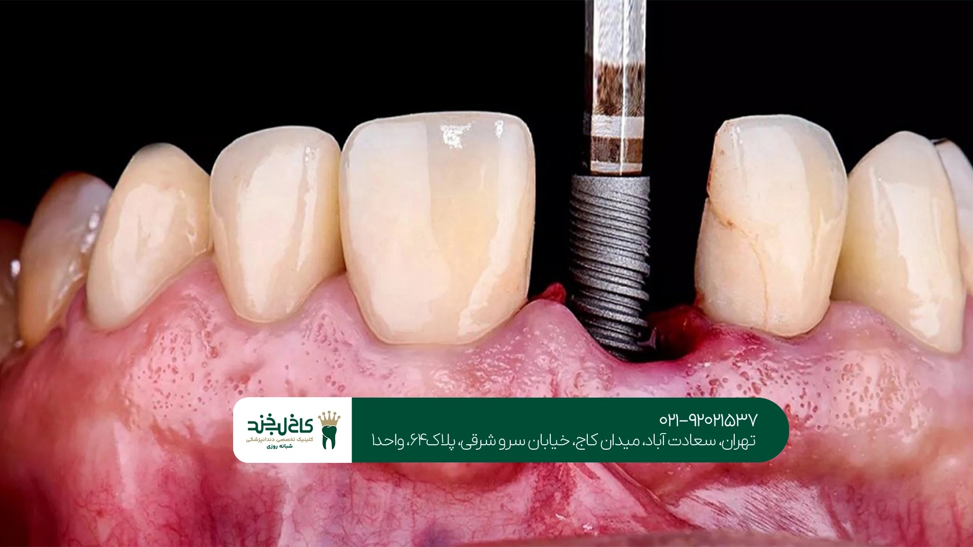 دندانپزشکی تخصصی ایمپلنت تهران