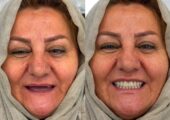 تفاوت دندان مصنوعی و اوردنچر
