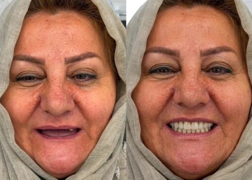تفاوت دندان مصنوعی و اوردنچر