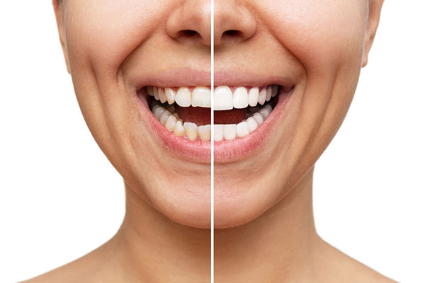 کامپوزیت یا لمینت؛ کدام هزینه بیشتری دارد؟
