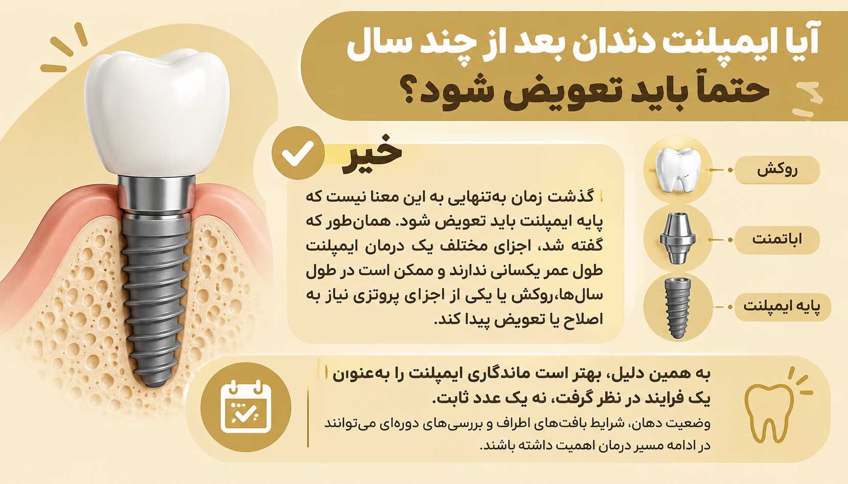 آیا ایمپلنت دندان بعد از چند سال حتما باید تعویض شود