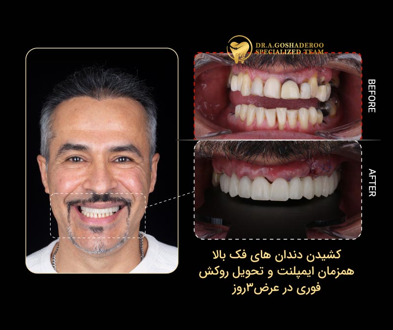 نمونه واقعی درمان در مرکز ایمپلنت دندان دکتر عزیز گشاده‌رو در تهران
