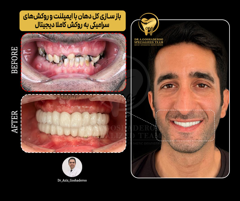نتیجه واقعی ایمپلنت دندان جلو و بازسازی زیبایی لبخند