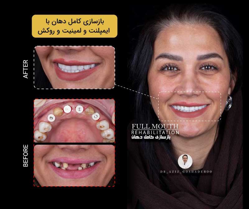 بازسازی چند دندان ازدست‌رفته با ایمپلنت توسط دکتر عزیز گشاده‌رو