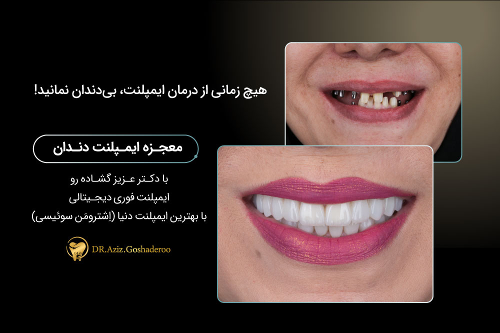نتیجه واقعی درمان ایمپلنت دندان جلو و بازسازی زیبایی لبخند