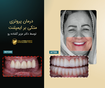 نمونه بازسازی چند دندان ازدست‌رفته با ایمپلنت توسط دکتر عزیز گشاده‌رو